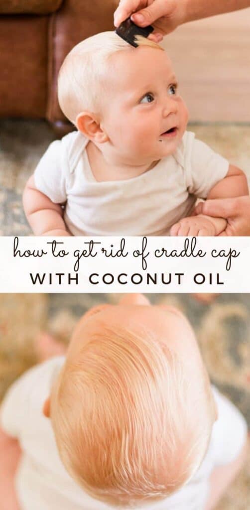 Baby oil shop for cradle cap