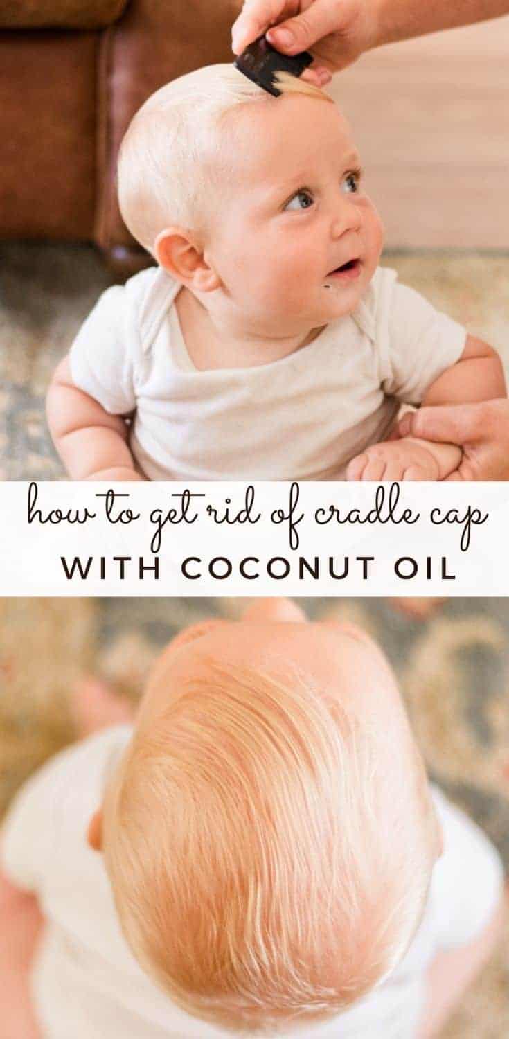 How to Get Rid of Cradle Cap with Coconut Oil Our Oily House
